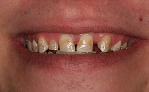 before dental treatment 2