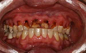 Decayed Teeth and Gum Disease