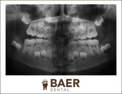 Family Dentist in Lone Tree Image of X Ray